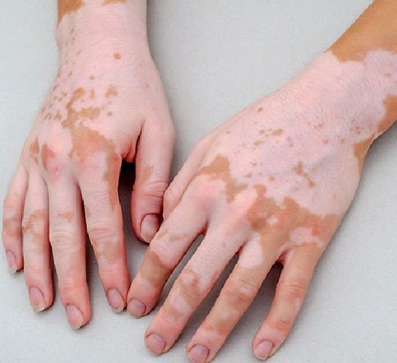 Psoriasis, Vitiligo & Skin Diseases